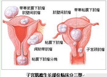 子宫肌瘤的隐在妇科症状--女性经期过长