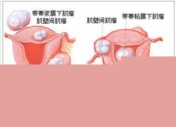 子宫肌瘤与宫颈肌瘤的分布图