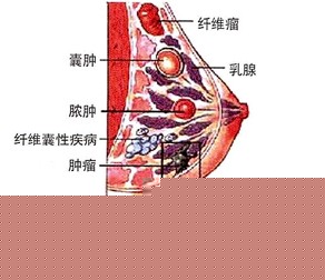 乳腺炎的前期症状表现