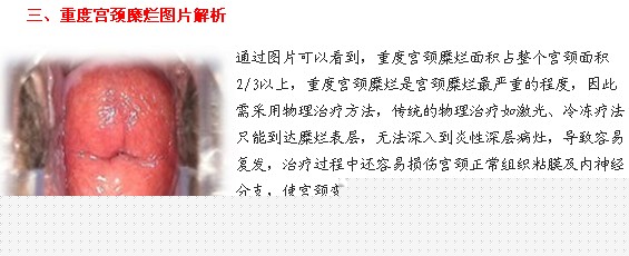 宫颈糜烂,宫颈糜烂图片,妇科病宫颈糜烂图片
